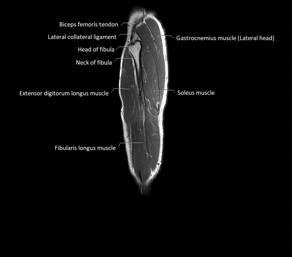 Lower leg sagittal anatomy 3T MRI image 7.webp